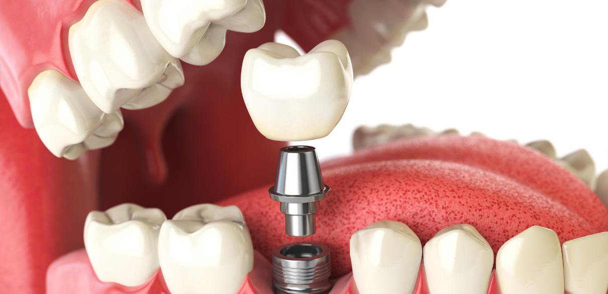 right dentist for dental implant procedure