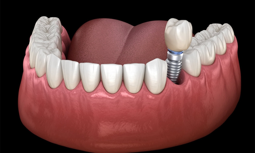 How Dental Implants Help Preserve Oral Health for the Future?
