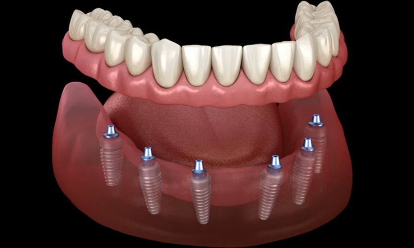 What To Eat After Dental Implant Surgery The Best And Worst Foods