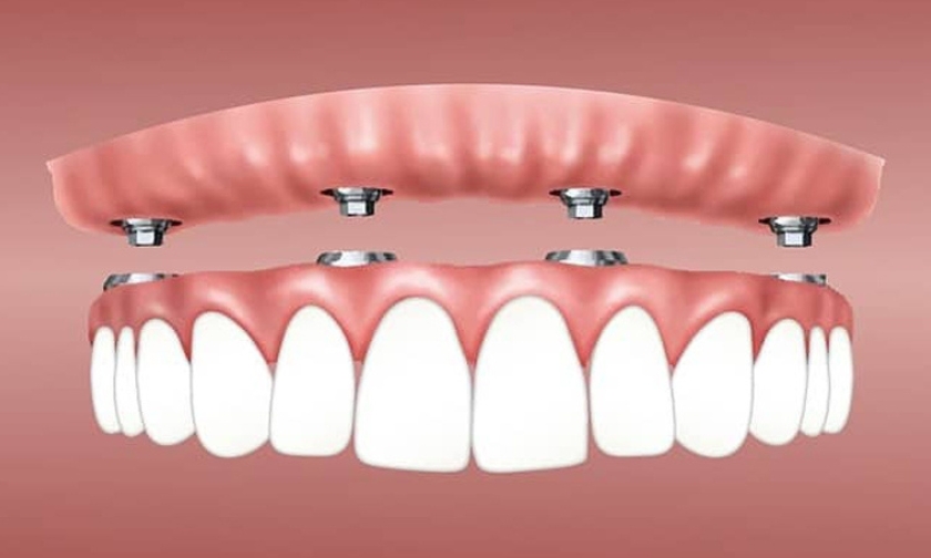What Are All-on-4 Implants and How Do They Work