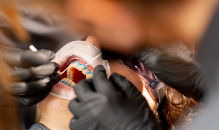 Dental Fillings