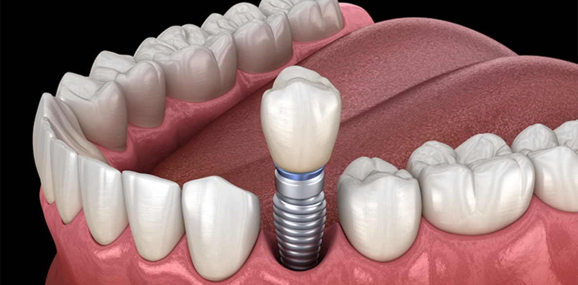 why dental implants are a long term investment in your smile