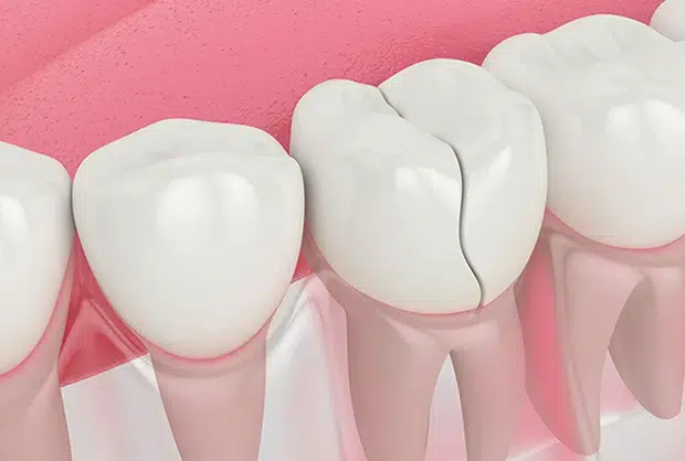 Chipped tooth