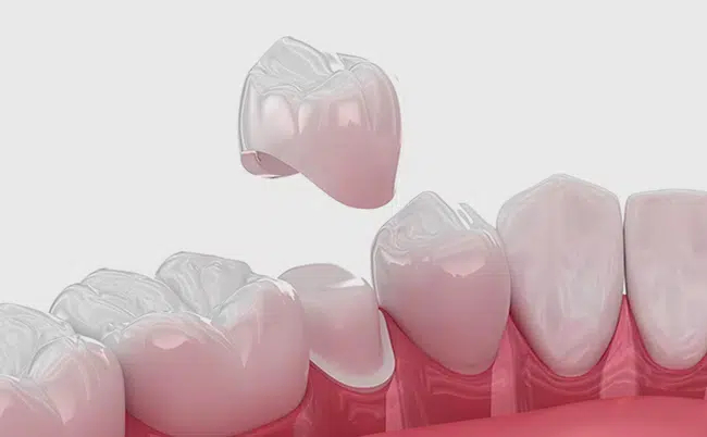 Dental Crown in Cary NC