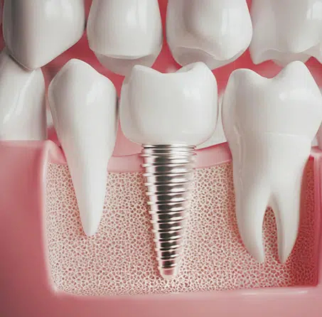 Dental Implants