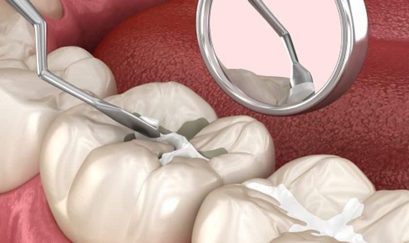 Dental Fillings in Culver City CA