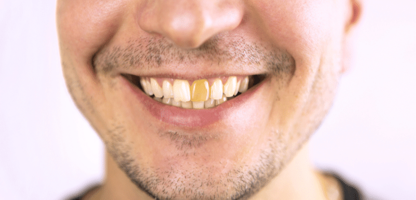Is Your Tooth Too Damaged to Save