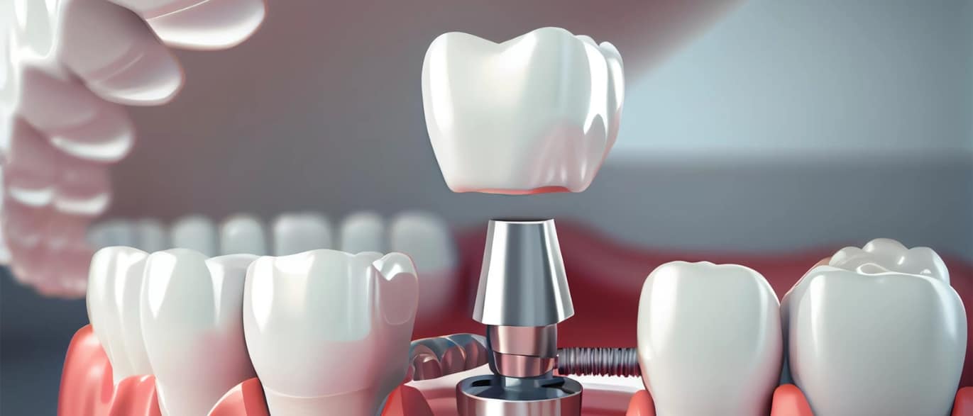 5 steps to increase the longevity of your dental implants