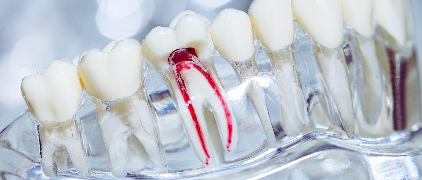 is root canal treatment painful