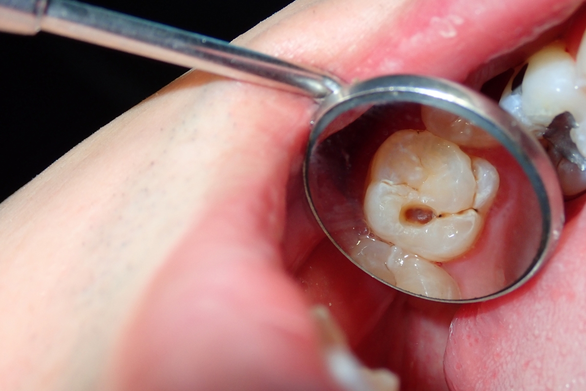 can you heal a cavity at home