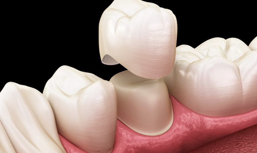 Do You Need a Dental Crown Signs You Shouldnt Ignore