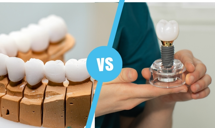 full-arch vs single-tooth dental implants