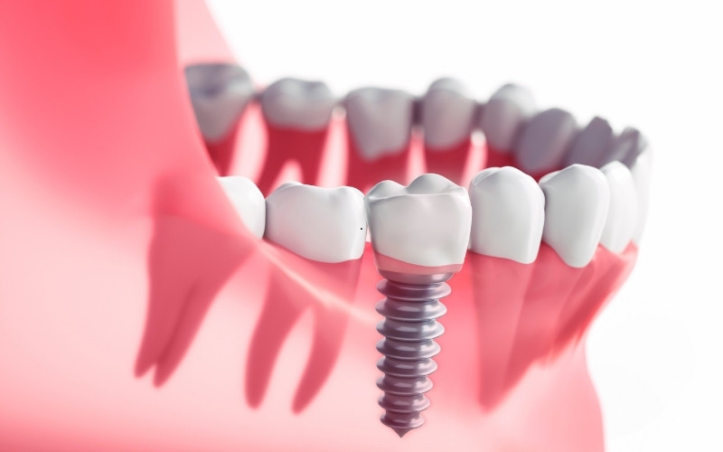 understand what are dental implants and how they work