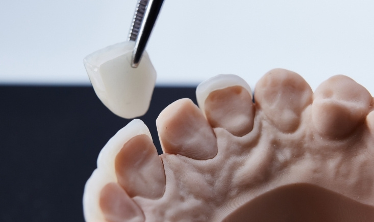 how to avoid common mistakes when getting veneers