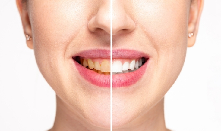 tips to prevent staining after teeth whitening