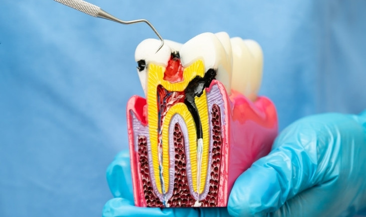 how long can you wait before getting a root canal