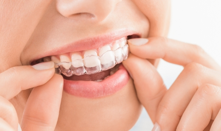 how to clean invisalign retainer with baking soda