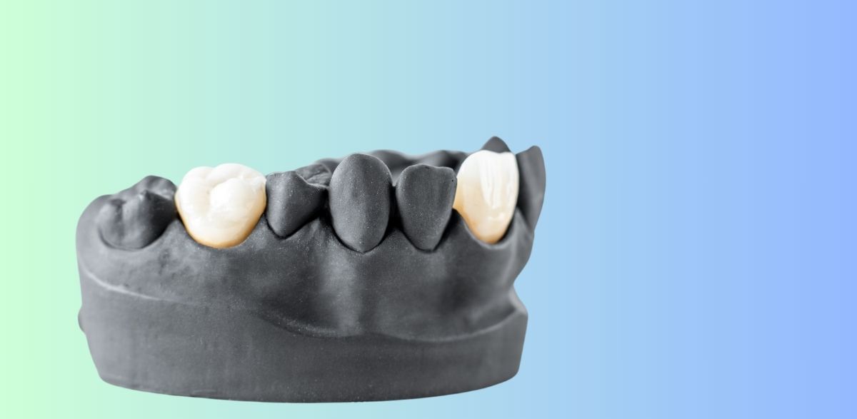 model of teeth with white dental crowns