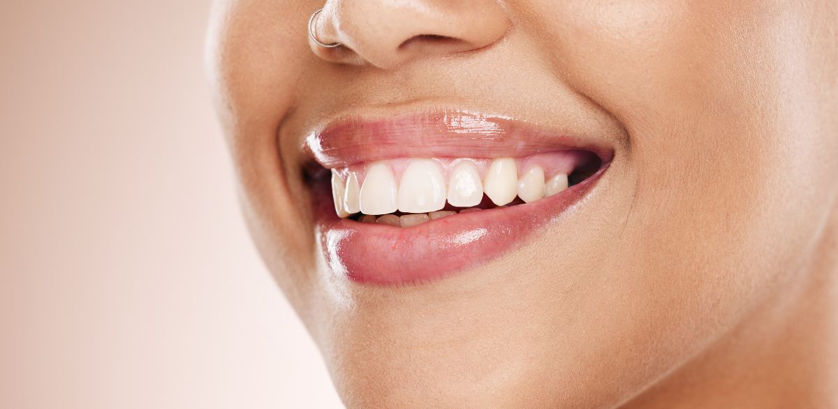 Close-up of a womans smile showing white teeth highlighting cosmetic dental work