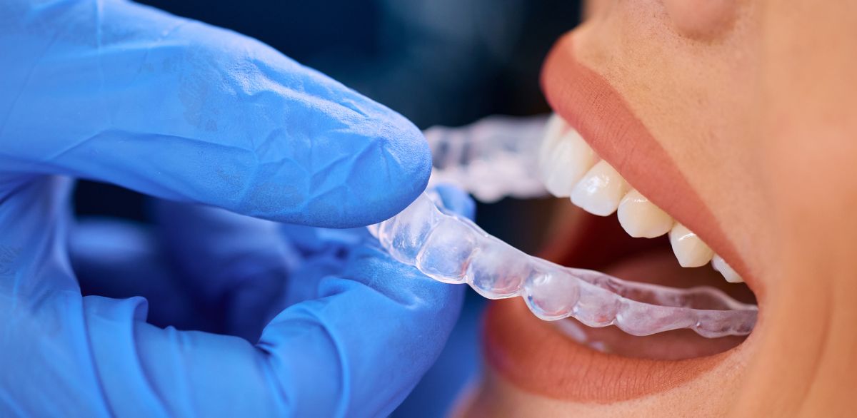 Close-up of a dentist fitting a clear aligner onto a patient teeth