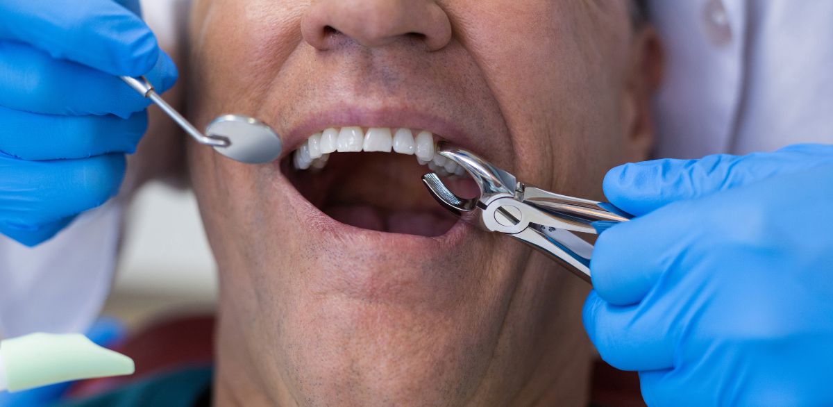 close-up of dentist performing tooth extraction on male patient in Grants pass