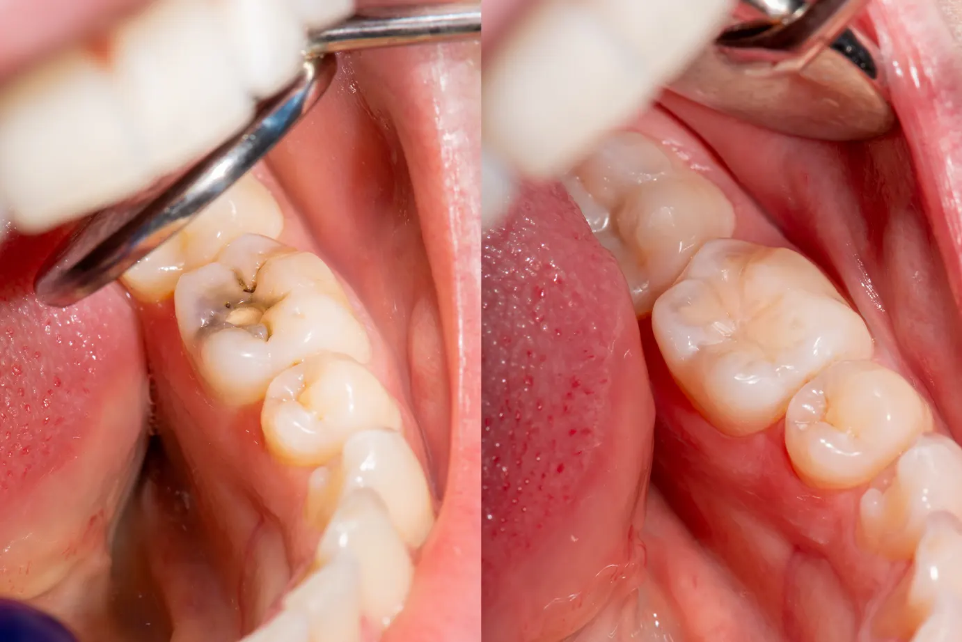 dental bonding grants pass