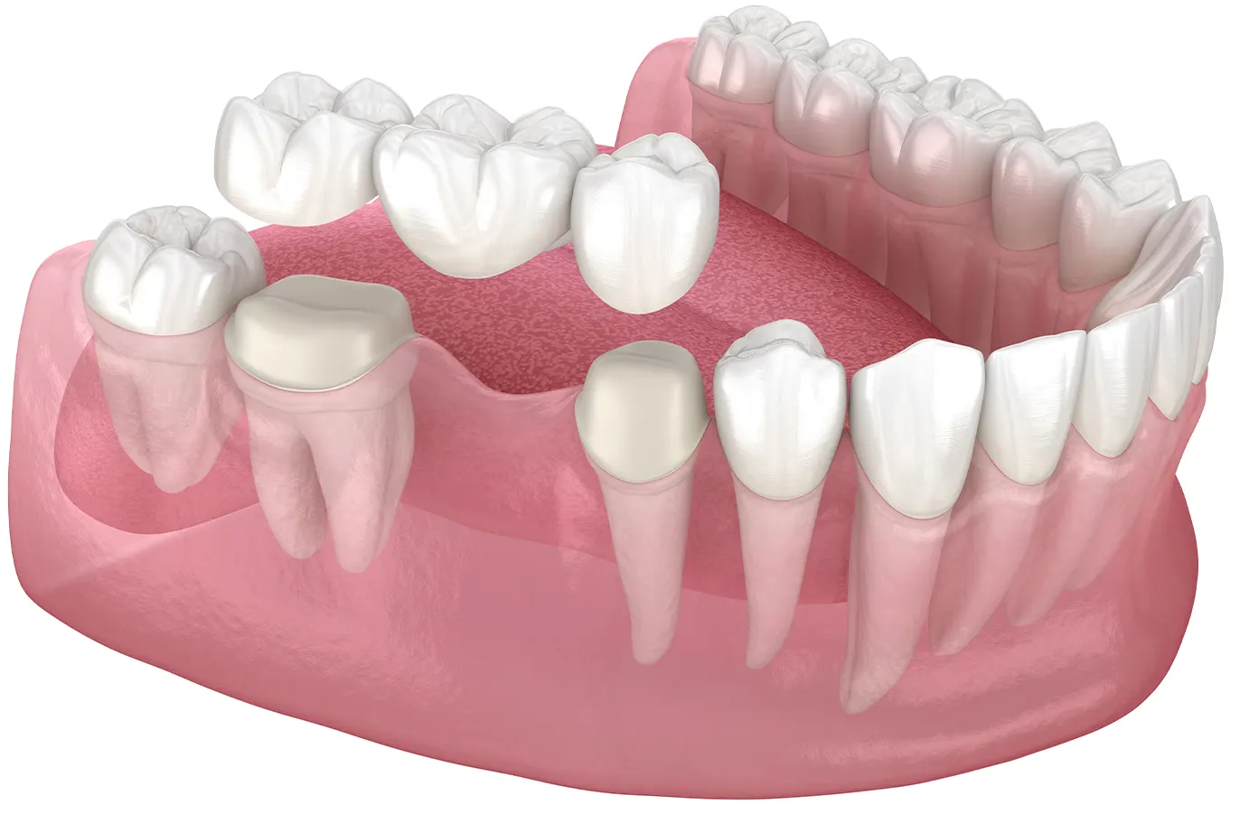 dental bridge grants pass