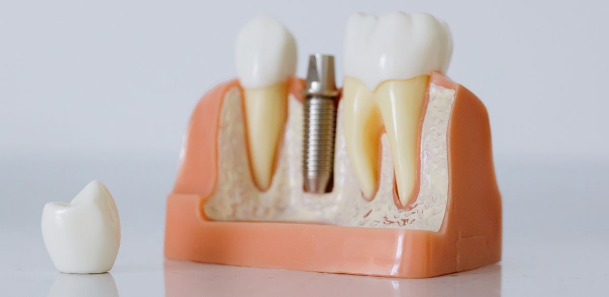 Cross-section model of dental implant in gums