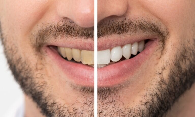 Teeth Whitening Trends And Tips - Avery Dental Wellness