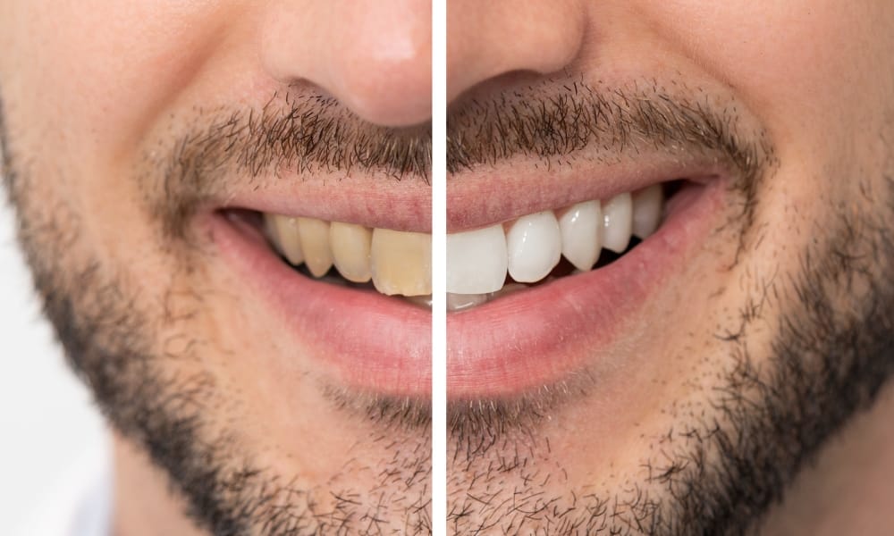 Teeth Whitening Trends And Tips - Avery Dental Wellness