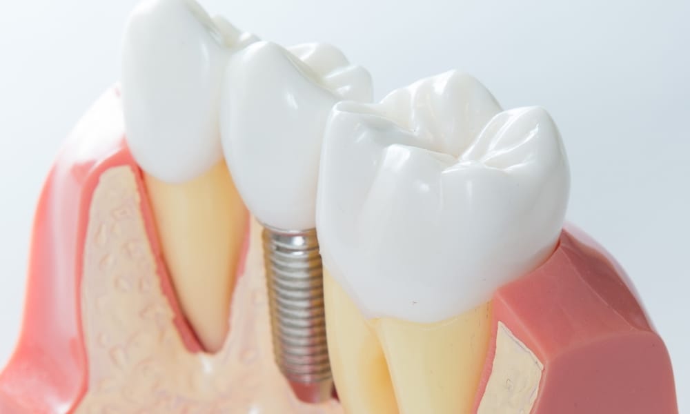 Dental Implants Complications