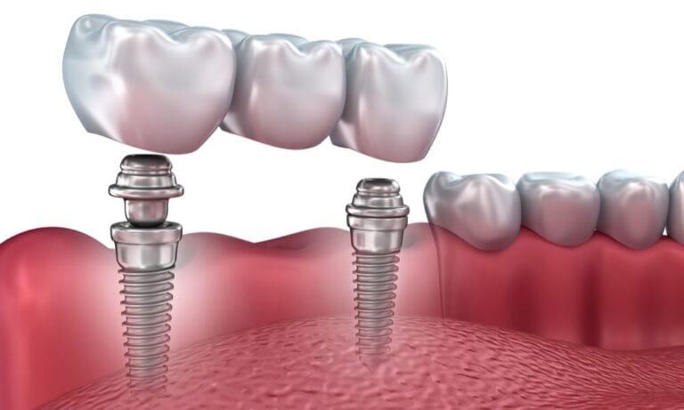 Why Should You Get Dental Implants
