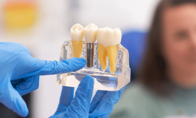 How Dental Implants Work