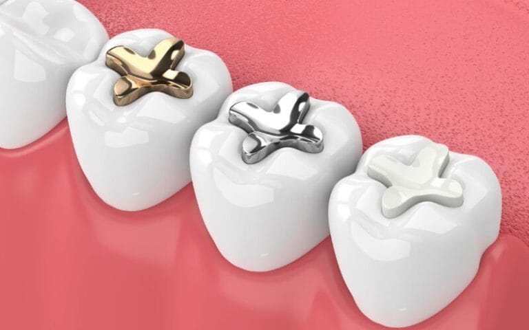 How to care for your dental fillings
