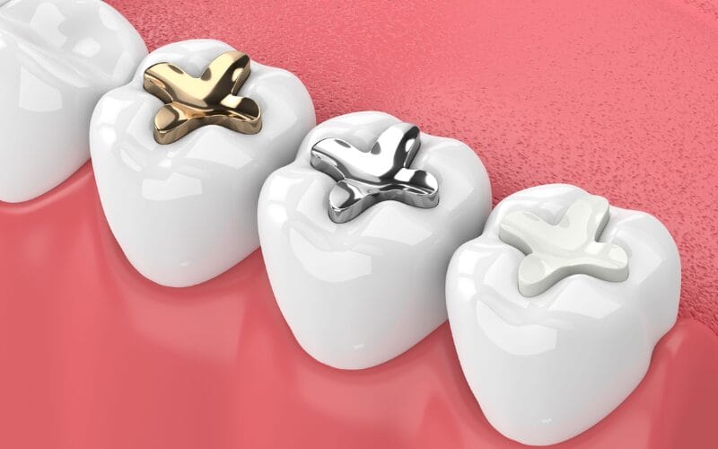 How to care for your dental fillings