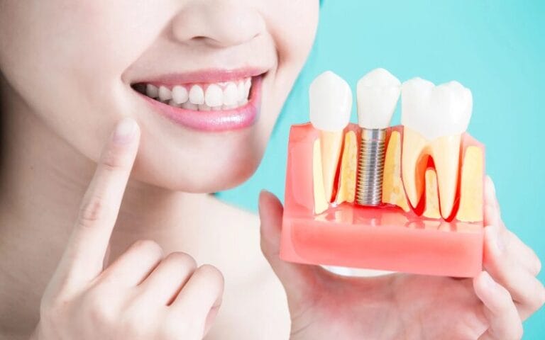 How To Clean Under Full Dental Implants