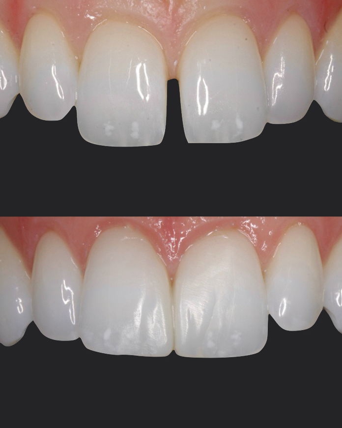 before and after close-up of teeth showing composite dental bonding results