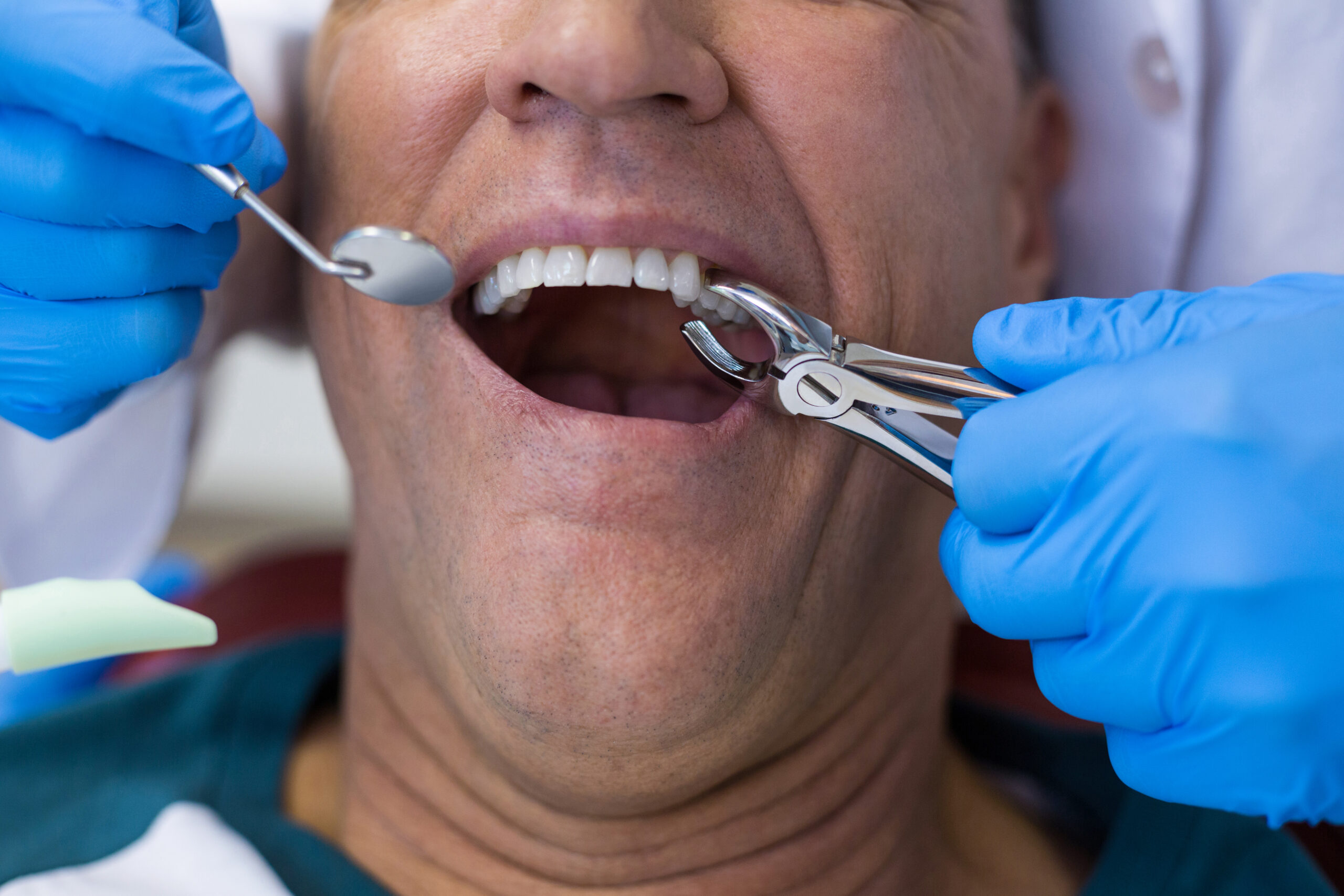 effective ways to stop tooth extraction bleeding
