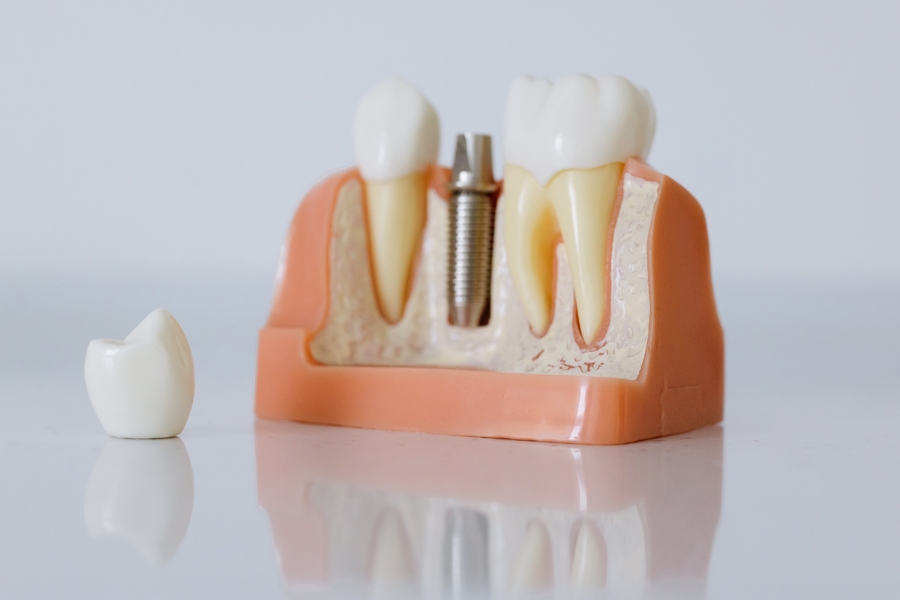 dental-implants-look-amazing-in-7-days