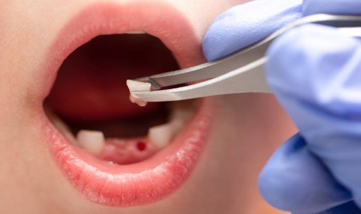 is it normal to have ear pain after tooth extraction