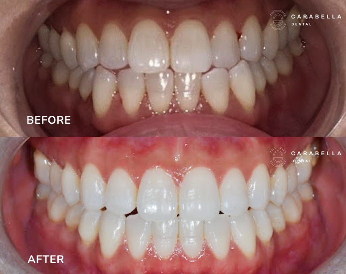 before and after smile transformations in alexandria at carabella dental