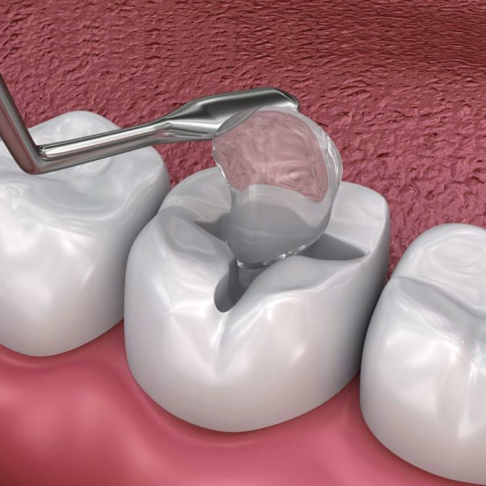 tooth receiving composite dental filling for cavity treatment in alexandria