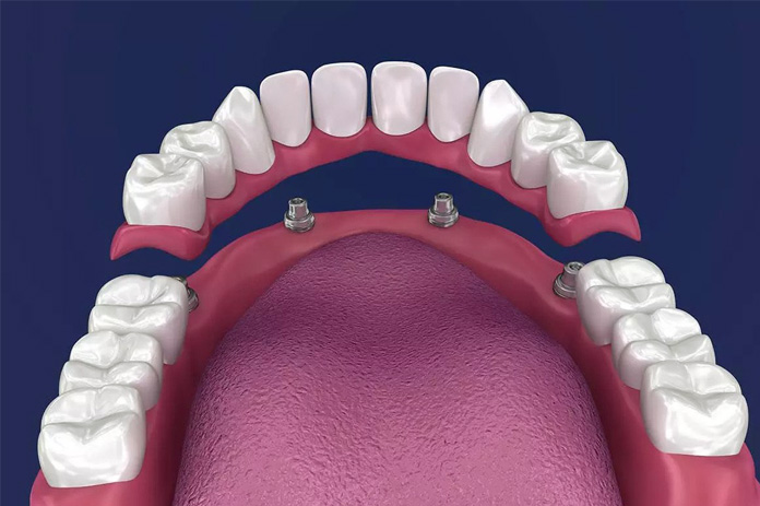 Illustration of implant-retained dentures placed in upper jaw in alexandria