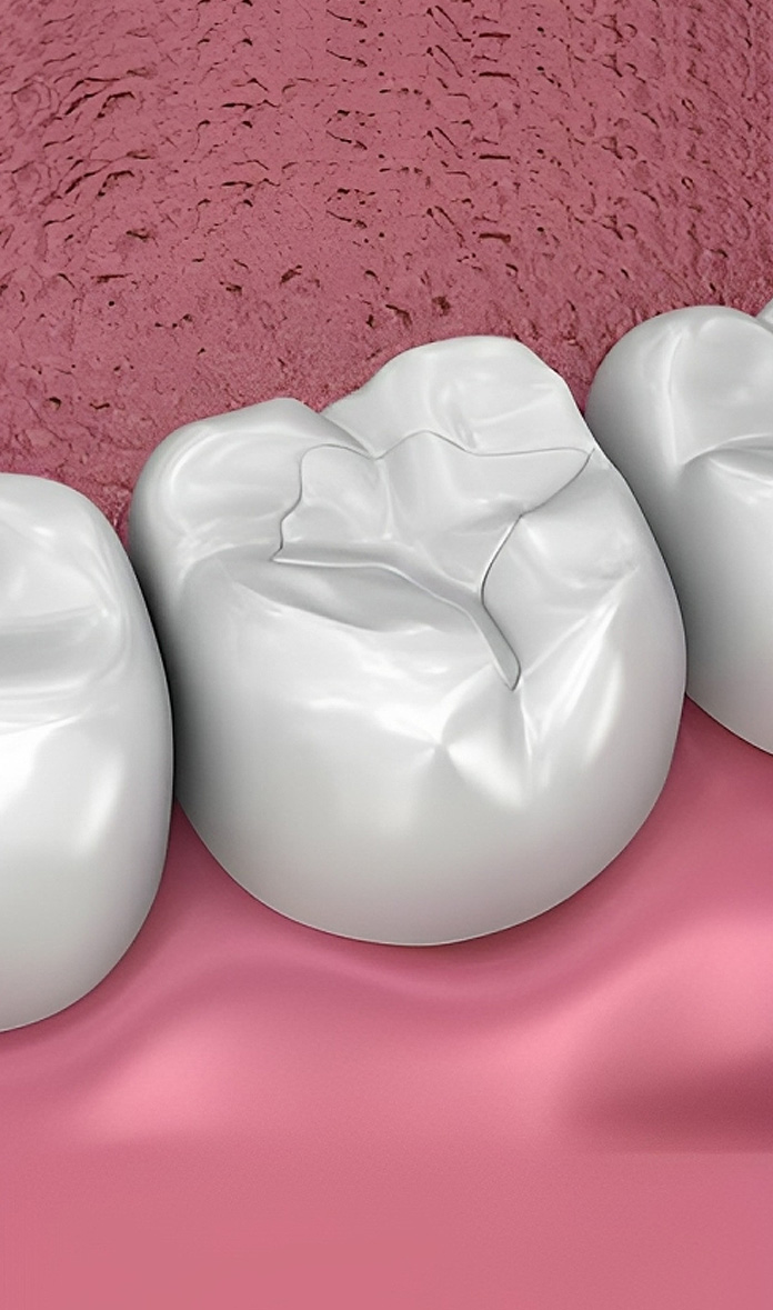 close-up illustration of tooth sealants on molars in alexandria