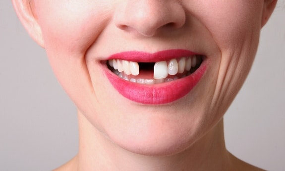 Featured image for “What Are The Best Options For Replacing Missing Teeth?”