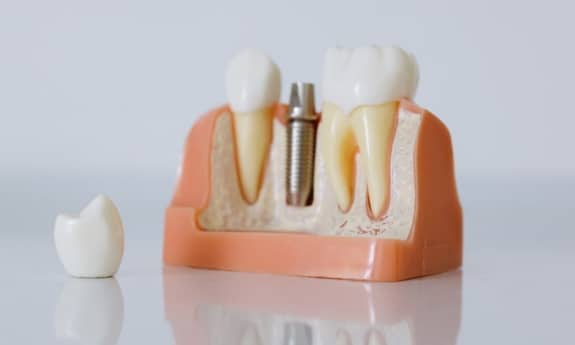 Featured image for “What Are The Symptoms Of A Loose Dental Implant?”