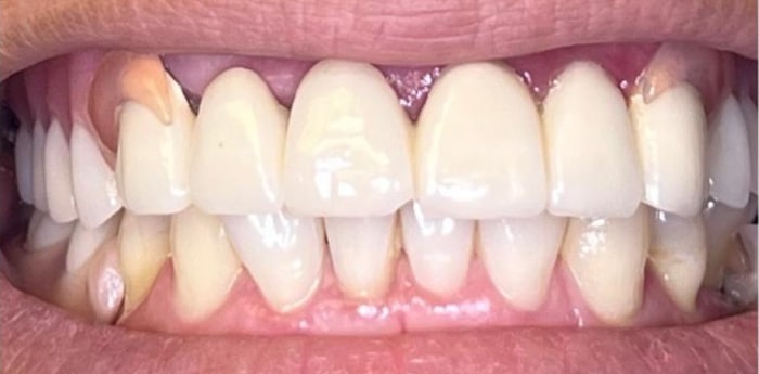 Implant Prosthesis Before
