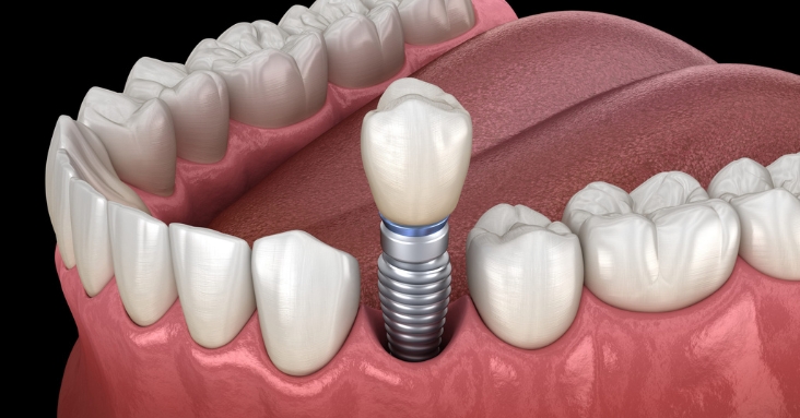 Protect Your Investment by Flossing Dental Implants