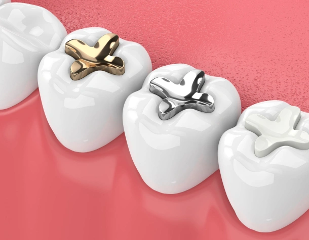 tooth colored fillings in fort worth tx - titanium dental & implants