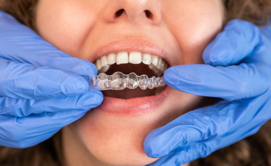 can invisalign fix gap between teeth